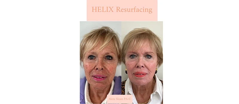 Before and After Images three | HELIX CO2 Laser Rejuvenation in Wilmington, NC | United Medical And Aesthetics