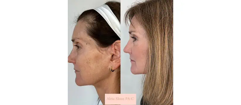 Before and After Images 3 | Helix in Wilmington, NC | United Medical And Aesthetics