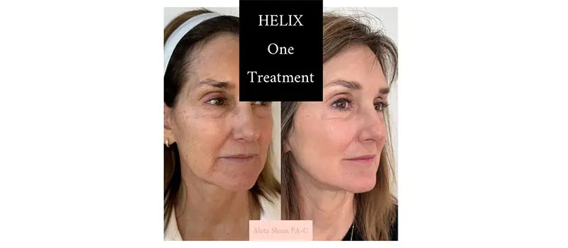 Before and After Images 4 | Helix in Wilmington, NC | United Medical And Aesthetics