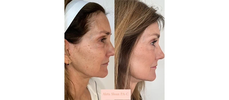 Before and After Images 5 | Helix in Wilmington, NC | United Medical And Aesthetics