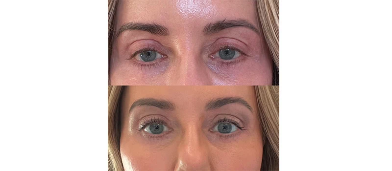 Before and After Images one | Non-Surgical Eye Lift in Wilmington, NC | United Medical And Aesthetics