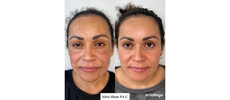 Before and After Images four | Skin Rejuvenation in Wilmington, NC | United Medical And Aesthetics