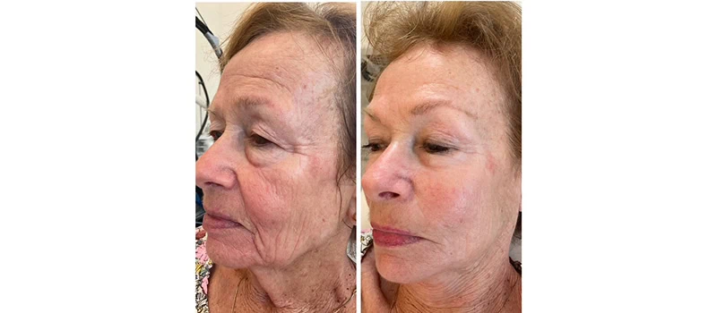 Before and After Images one | Skin Rejuvenation in Wilmington, NC | United Medical And Aesthetics