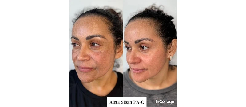 Before and After Images three | Skin Rejuvenation in Wilmington, NC | United Medical And Aesthetics