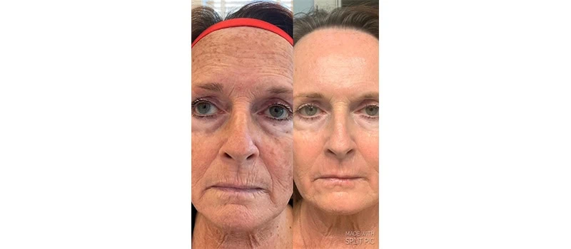 Before and After Images two | Skin Rejuvenation in Wilmington, NC | United Medical And Aesthetics