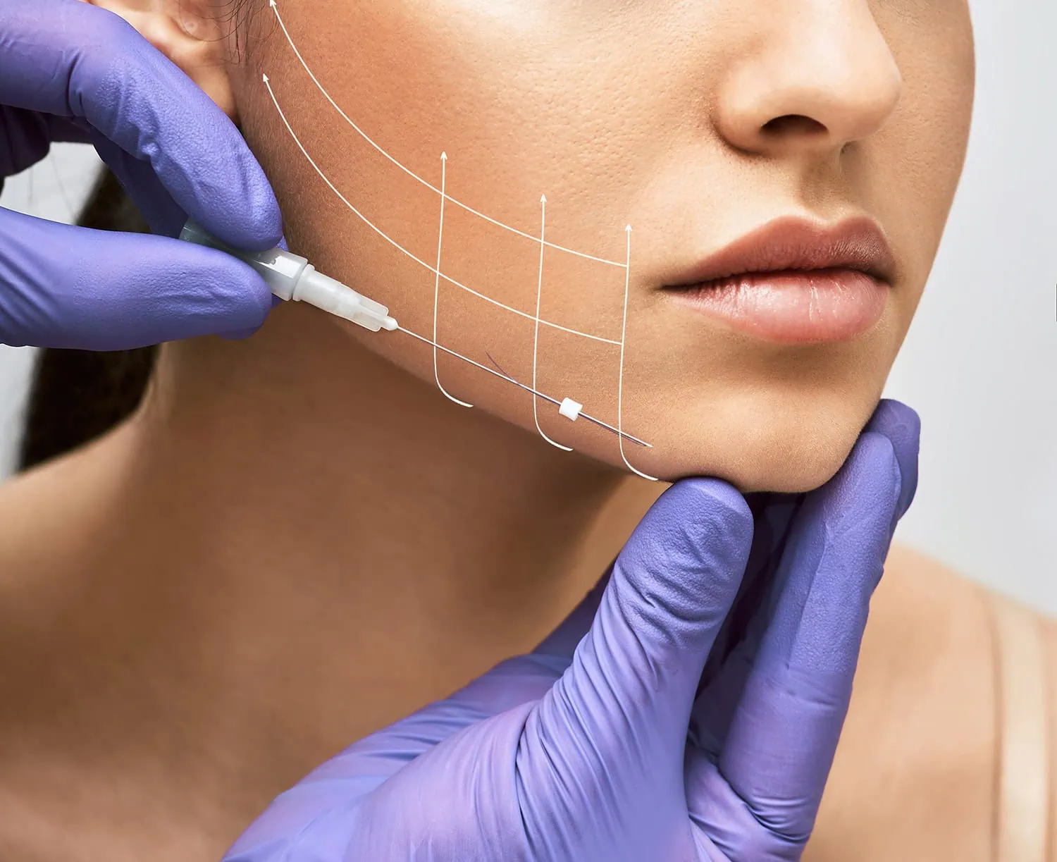 V Soft Lift Rejuvenation Lifting Threads Services