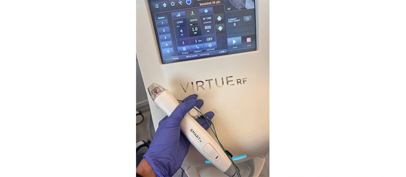 A hand holding a Virtue-RF device | United Medical And Aesthetics in Wilmington, NC