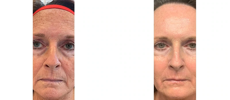 before-and-after-results-of-co2-laser-skin-resurfacing