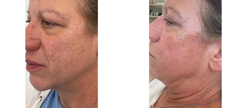 co2-laser-skin-resurfacing-ba-one