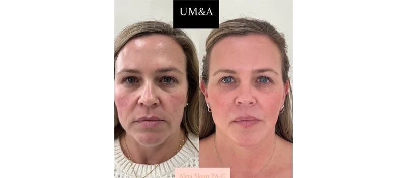 Before and After Images | Dermal in Wilmington, NC | United Medical And Aesthetics