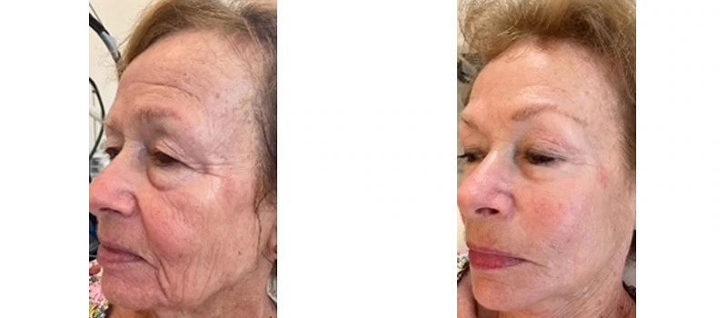 facial-rejuvenation-bna-four