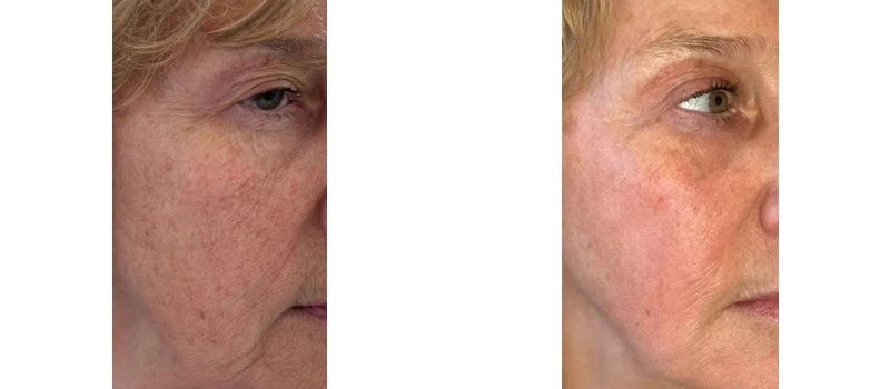 a close-up of a woman's face before and after helix co2 laser rejuvenation bna case