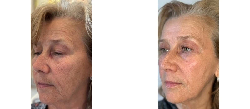 a collage of a woman's face helix co2 laser rejuvenation bna case