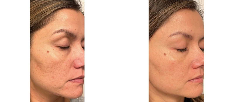 woman's face after helix co2 laser rejuvenation