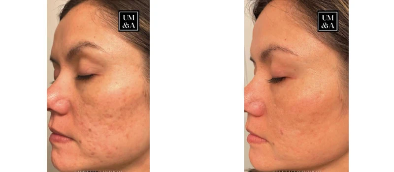 a woman's face before and after helix co2 laser