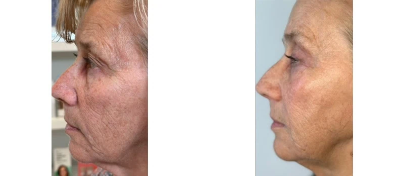 a side view of a woman's face helix co2 laser rejuvenation bna case