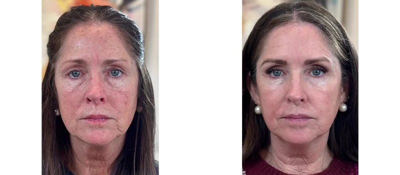 laser-skin-resurfacing-one