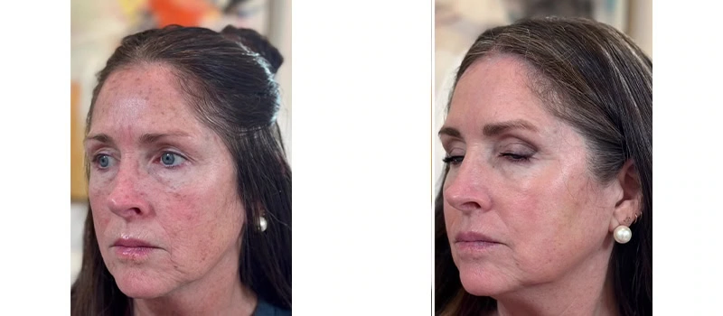 laser-skin-resurfacing-three