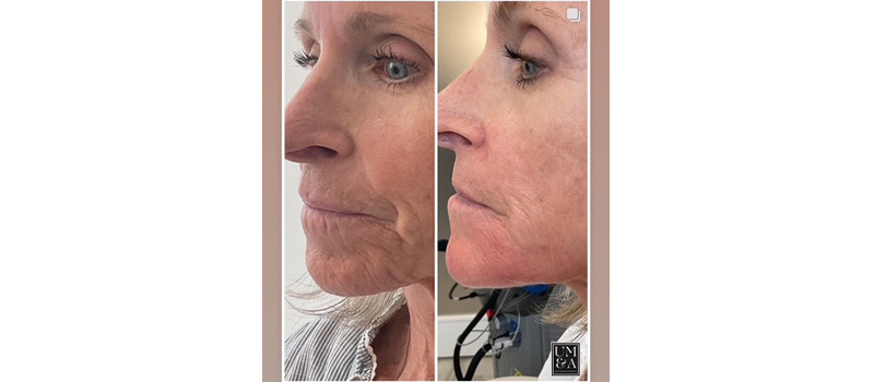 Mid-Aged Woman Before and After Dermal Fillers Treatment Images | United Medical And Aesthetics in Wilmington, NC