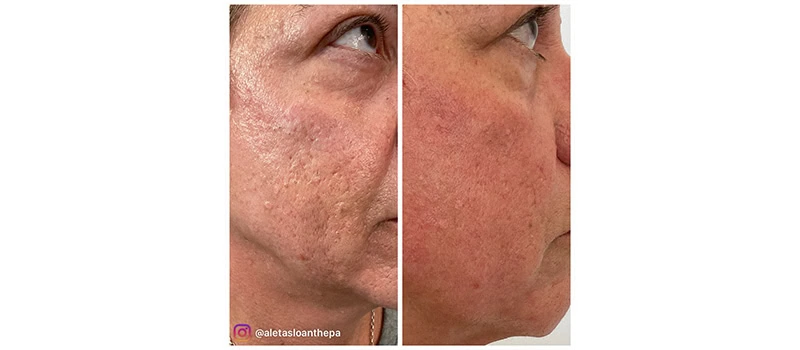 Before and After Images eleven | HELIX CO2 Laser Rejuvenation in Wilmington, NC | United Medical And Aesthetics