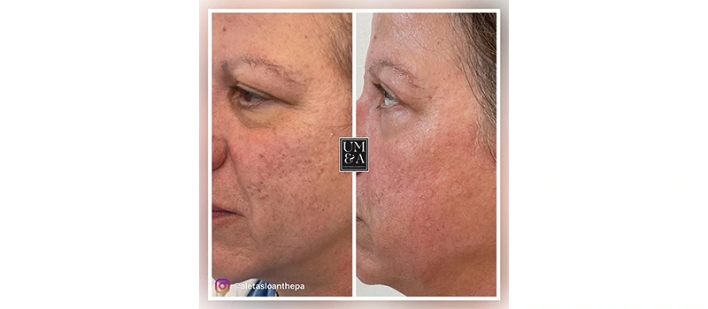 Before and After Images | HELIX CO2 Laser Rejuvenation in Wilmington, NC | United Medical And Aesthetics