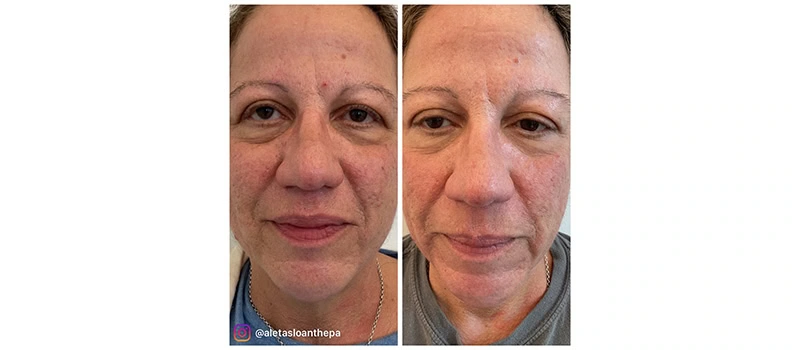 Before and After Images ten | HELIX CO2 Laser Rejuvenation in Wilmington, NC | United Medical And Aesthetics