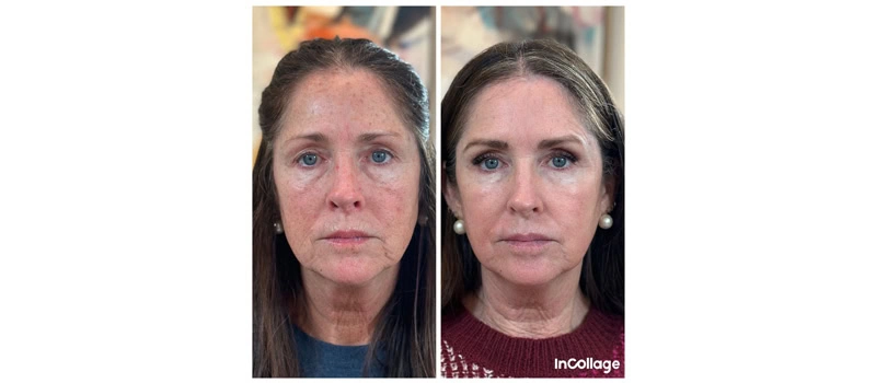 Before and After Images eight | HELIX CO2 Laser Rejuvenation in Wilmington, NC | United Medical And Aesthetics