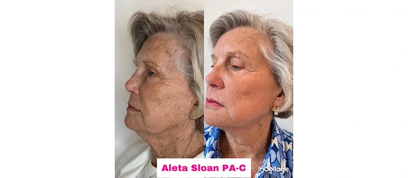 Mid-Aged Woman Before and After Nordlys Light and Bright Treatment Images | United Medical And Aesthetics in Wilmington, NC