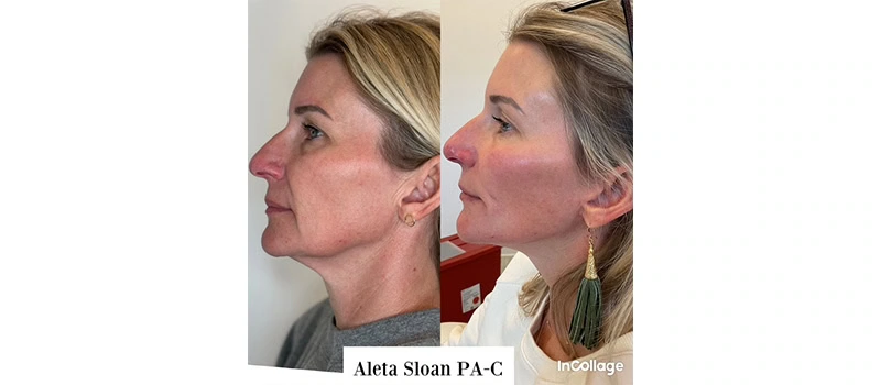 Mid-Aged Woman Before and After Restylane Treatment Images | United Medical And Aesthetics in Wilmington, NC