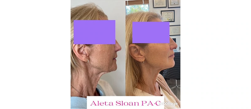 Mid-Aged Woman Before and After Restylane Treatment Images | United Medical And Aesthetics in Wilmington, NC