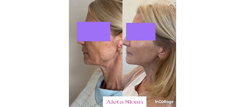 Mid-Aged Woman Before and After Restylane Treatment Images | United Medical And Aesthetics in Wilmington, NC