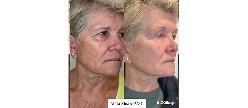 Mid-Aged Woman Before and After Virtue-RF Treatment Images | United Medical And Aesthetics in Wilmington, NC