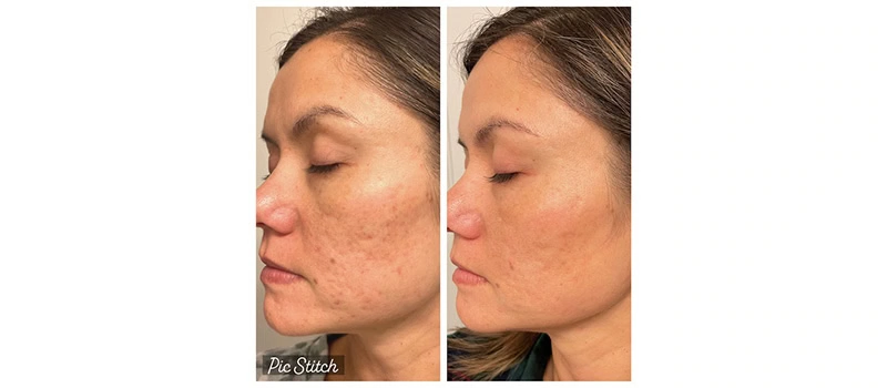 Woman Before and After CO2 Laser Resurfacing Treatment Images | United Medical And Aesthetics in Wilmington, NC