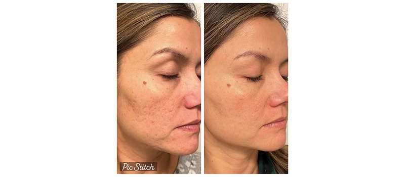 Woman Before and After CO2 Laser Resurfacing Treatment Images | United Medical And Aesthetics in Wilmington, NC