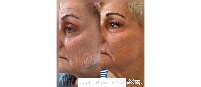 Mid-Aged Woman Before and After CO2 Laser Treatment Images | United Medical And Aesthetics in Wilmington, NC