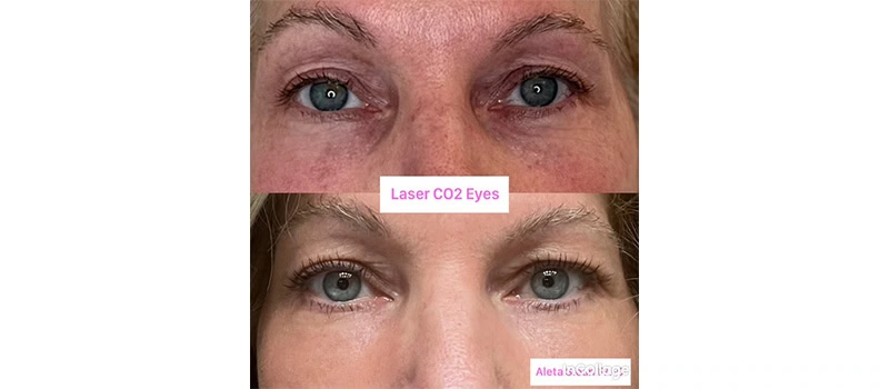 Mid-Aged Woman Before and After CO2 Laser Resurfacing Treatment Images | United Medical And Aesthetics in Wilmington, NC