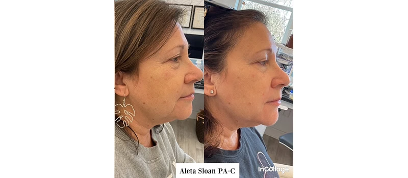 dermal-filler-after-before-five