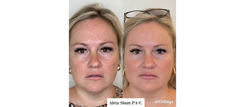 Mid-Aged Woman Before and After Botox Treatment Images | United Medical And Aesthetics in Wilmington, NC