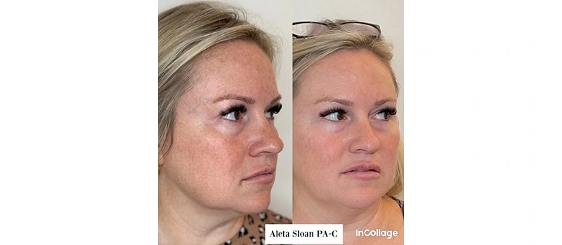 Mid-Aged Woman Before and After Botox Treatment Images | United Medical And Aesthetics in Wilmington, NC