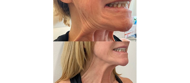 Before and After Images | Neuromodulators in Wilmington, NC | United Medical And Aesthetics