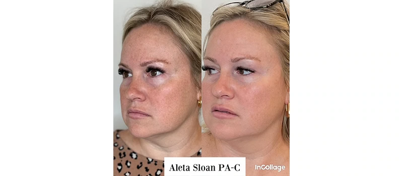 Mid-Aged Woman Before and After Botox Treatment Images | United Medical And Aesthetics in Wilmington, NC